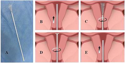 An Efficacious Endometrial Sampler for Screening Endometrial Cancer